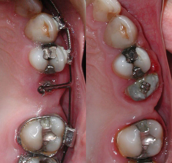 Root Extrusion for Crown Placement